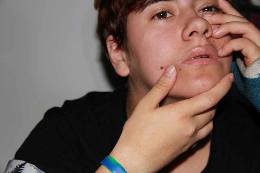 Acne Scarring