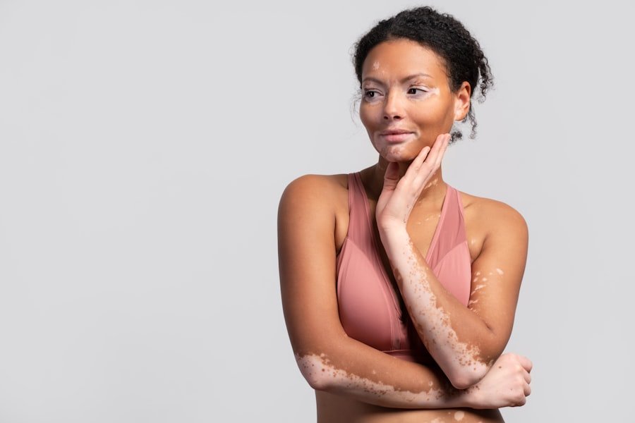 Reduce Acne