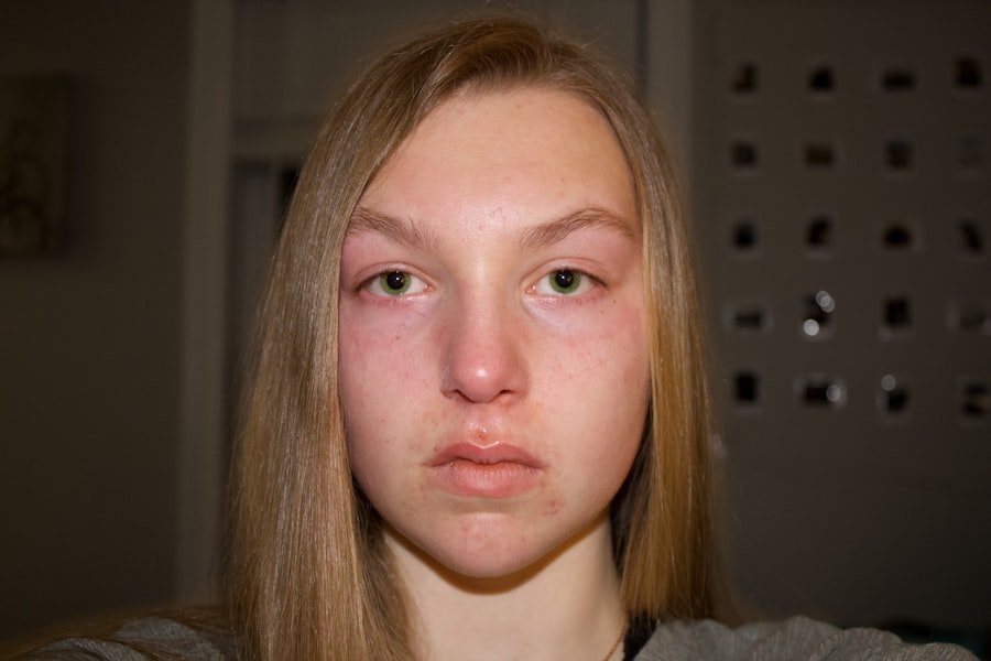 Hormonal Acne