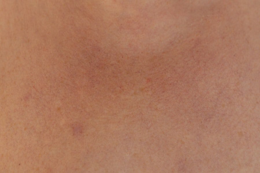 Acne Scars