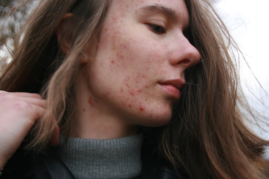 Scars