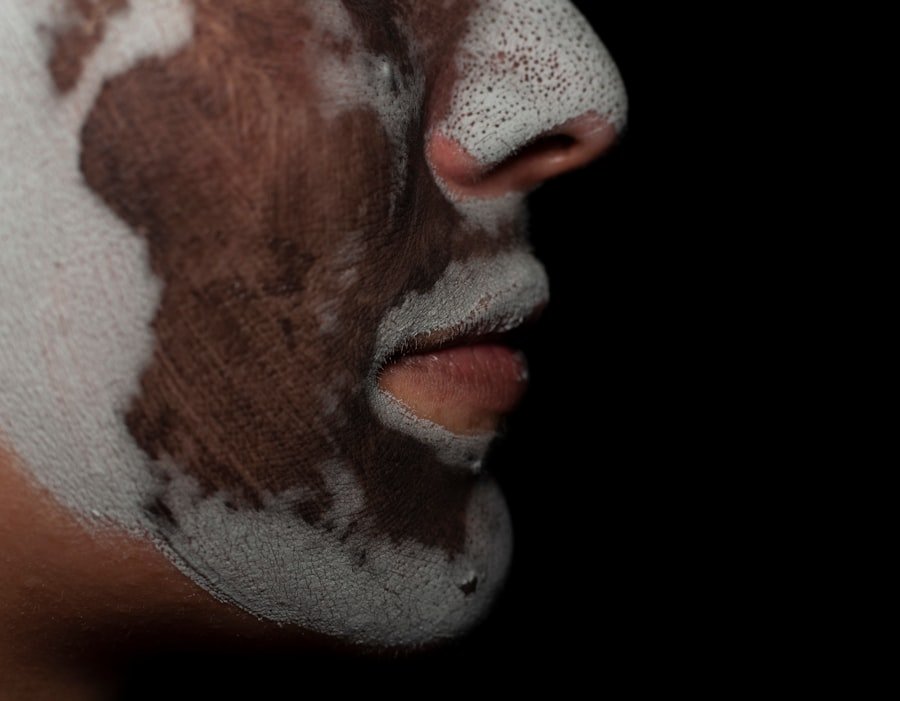 Hyperpigmentation