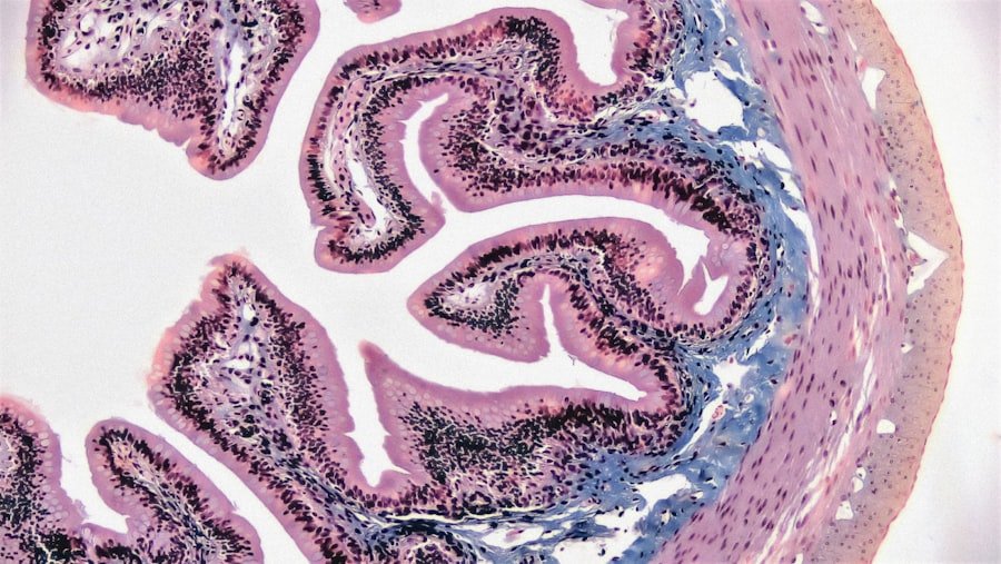 Vestibular Schwannoma