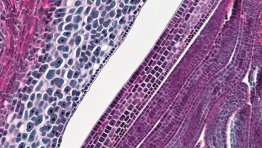 Vestibular Schwannoma