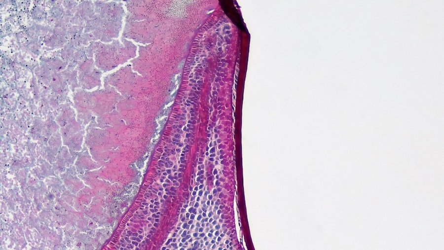 Vestibular Schwannoma