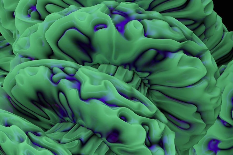 Acoustic Neuroma Imaging Results
