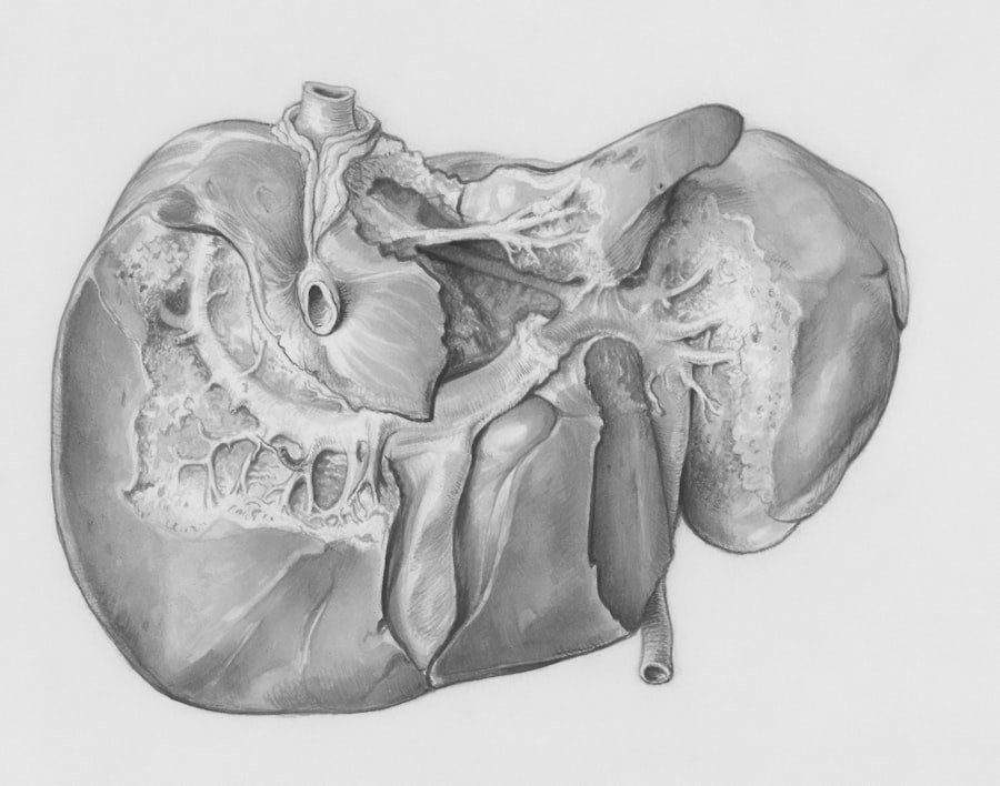 Vestibular Schwannoma