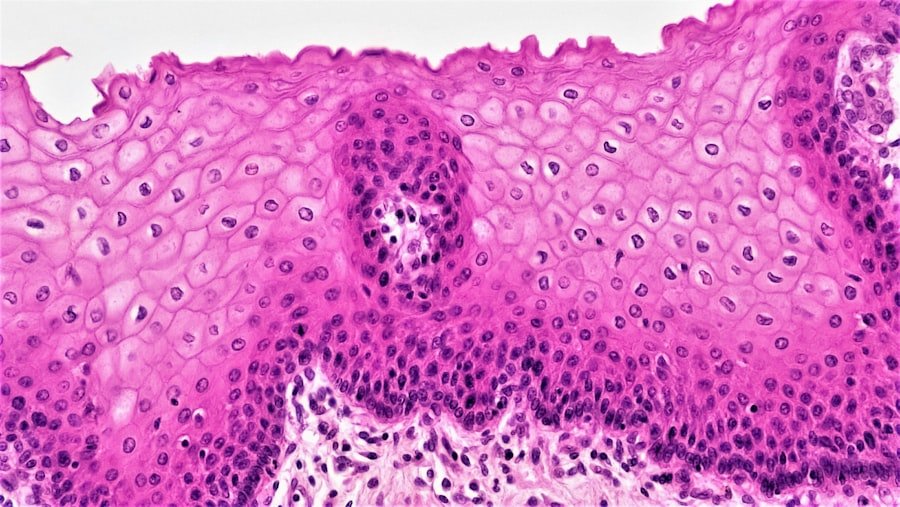 Larger Tumors