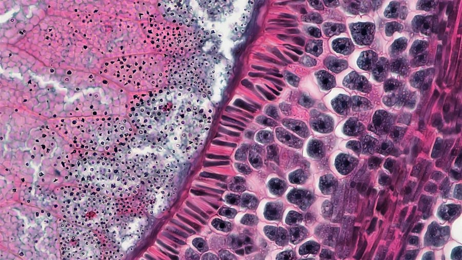Vestibular Schwannoma