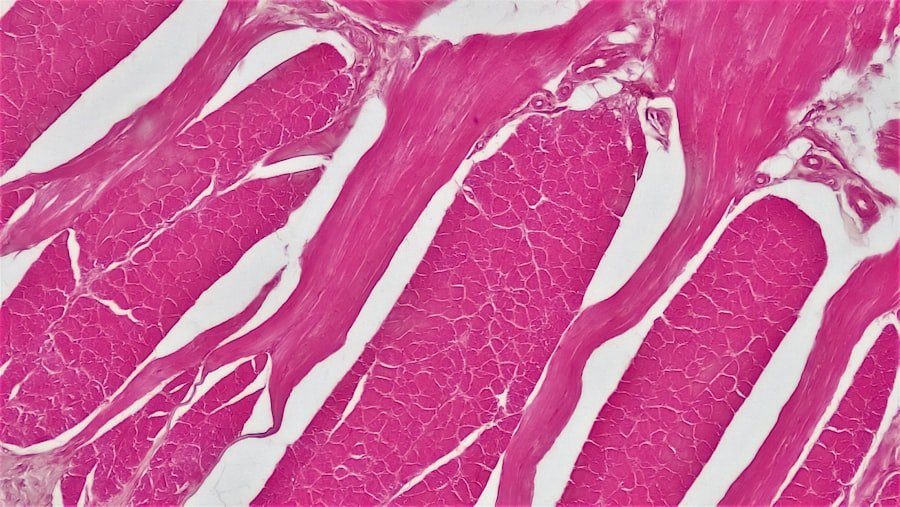 Photo Vestibular Schwannoma