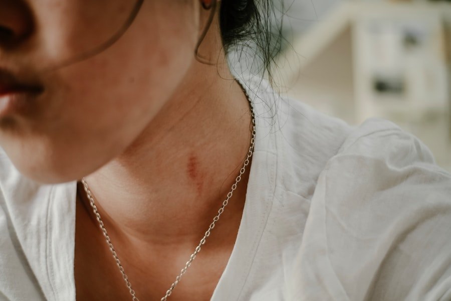 Photo Trigger Acne