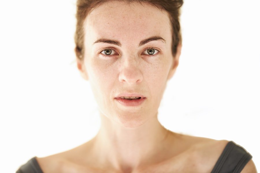 Photo Acne During Menopause