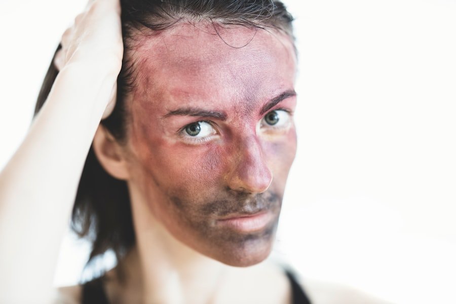 Photo Hormonal Acne