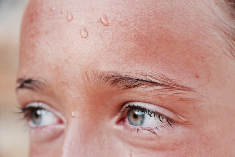 Photo Hormonal Acne