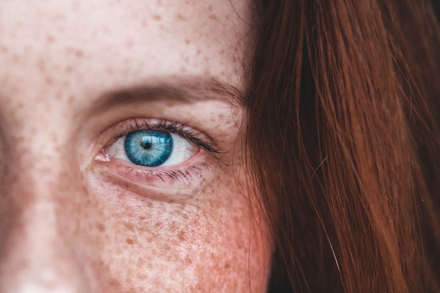 Photo Hyperpigmentation