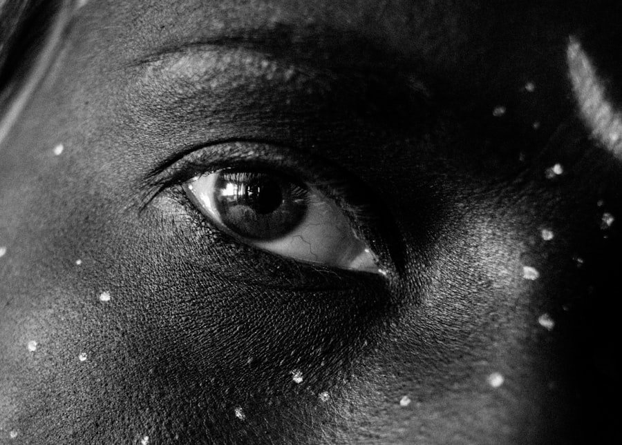 Photo Hyperpigmentation