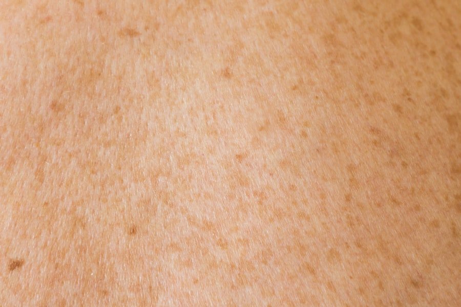 Photo Acne Marks