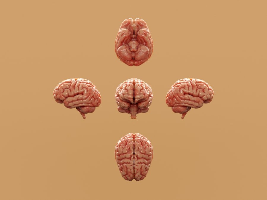 Photo Acoustic Neuroma Symptoms