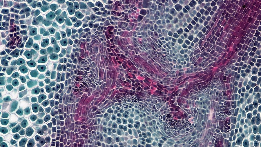 Photo Vestibular Schwannoma