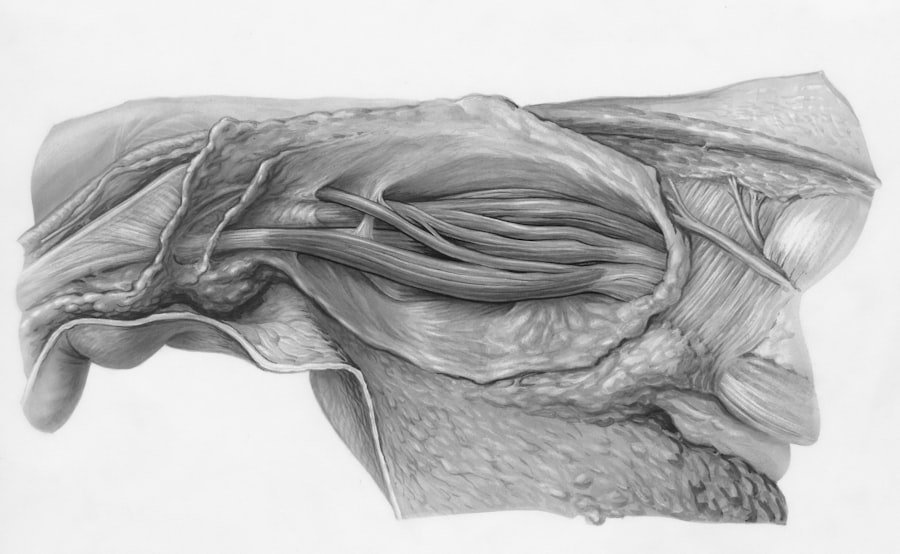Photo Vestibular Schwannoma