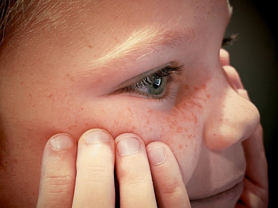 Eczema