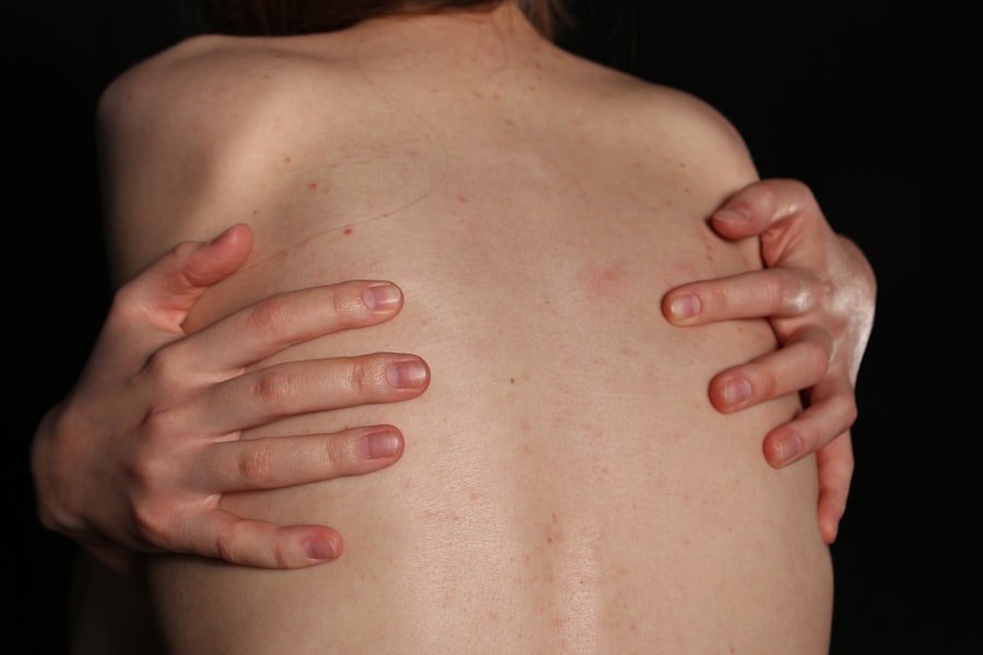 Photo Eczema Flare-Ups
